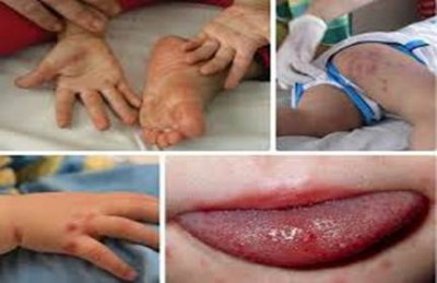 Hiện nay là thời điểm căn bệnh tay chân miệng ở trẻ em đang có nguy cơ gia tăng, có thể bùng phát dịch. Đây là bệnh nhiễm vi rút cấp tính, lây truyền qua đường tiêu hóa, thường gặp ở trẻ nhỏ dưới 5 tuổi.